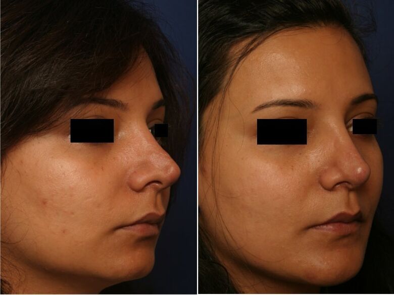 plastic surgery result