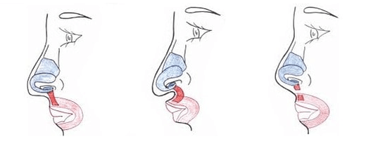 Truncation of part of the nasal muscle