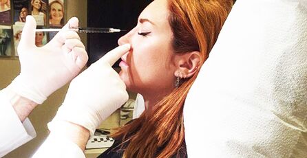 Rhinoplasty procedure using fillers