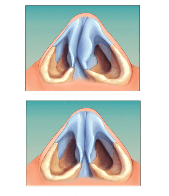 nasal septum corrected