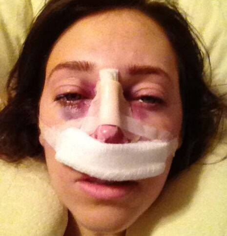 After the operation, a plaster bandage is applied to the nose