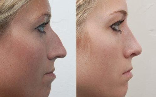 Before and after non-surgical rhinoplasty