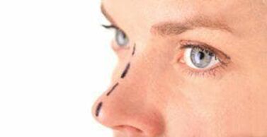 Marking on the nose for insertion of cosmetic threads
