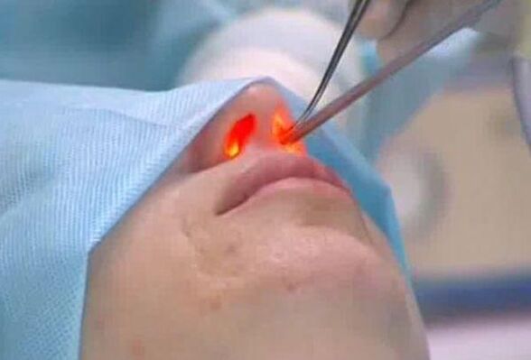 laser rhinoplasty of the nose
