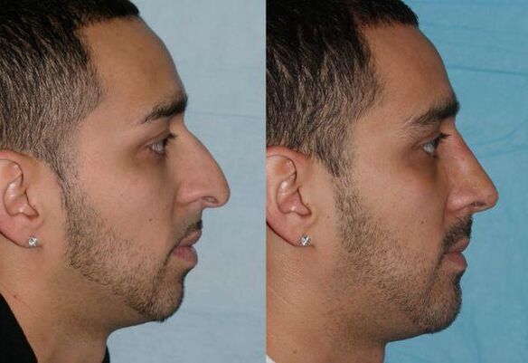 nose correction for men
