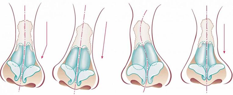 With a curvature of the nasal septum deviates from the rectilinear axis