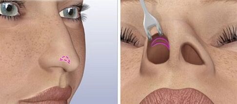 closed rhinoplasty of the nose