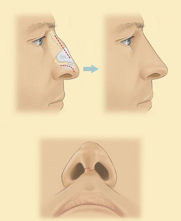 nose rhinoplasty diagram