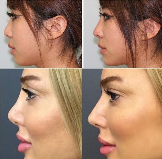 photos before and after non-surgical rhinoplasty