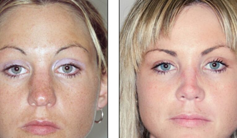 Before and after a failed nasal rhinoplasty