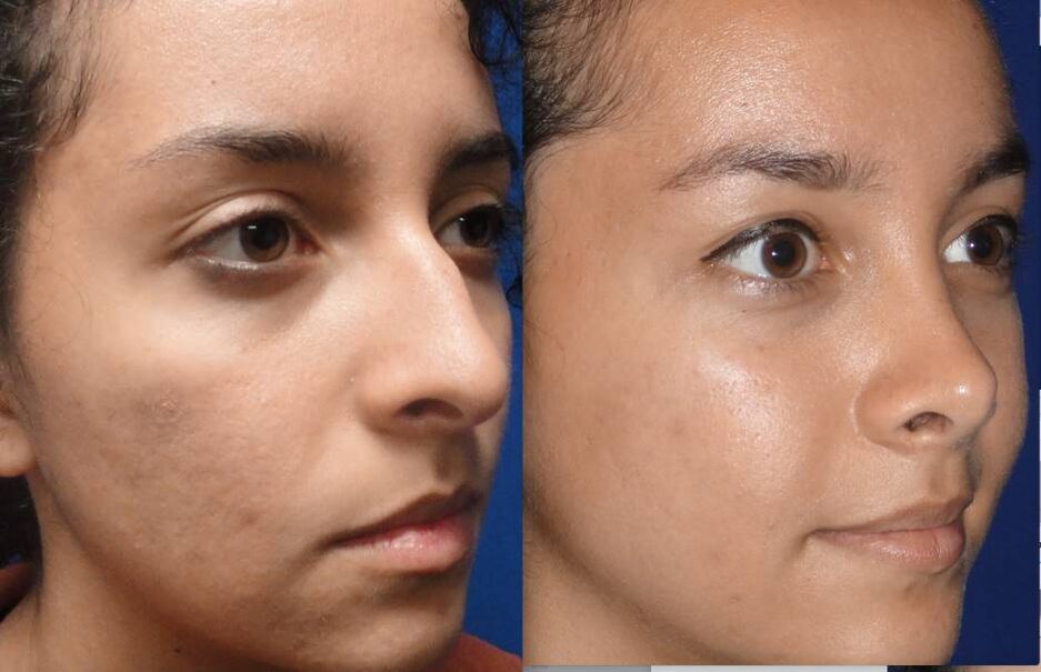 photos before and after closed rhinoplasty
