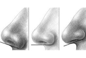 Correction of the tip of the nose in Israel