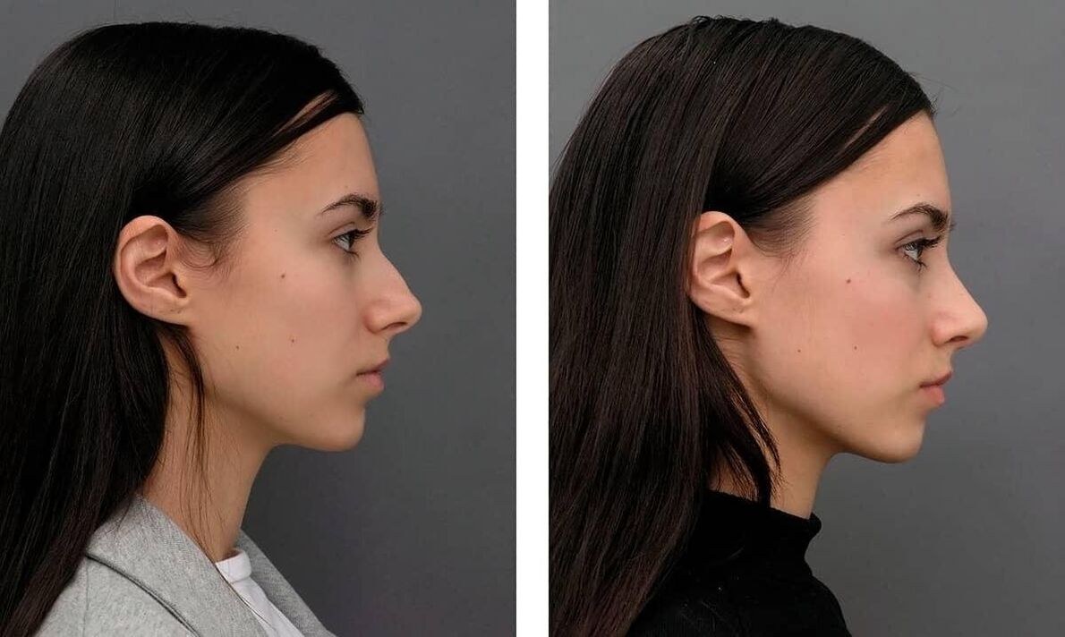 pictures before and after rhinoplasty