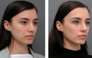 Girl before and after nose surgery