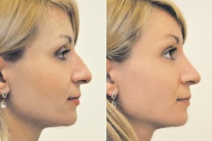 Non-invasive rhinoplasty photo before and after